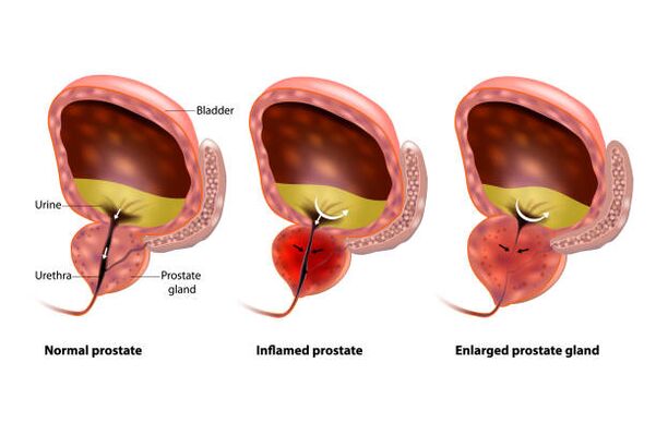 Prostatitis ist eine Entzündung der Prostata